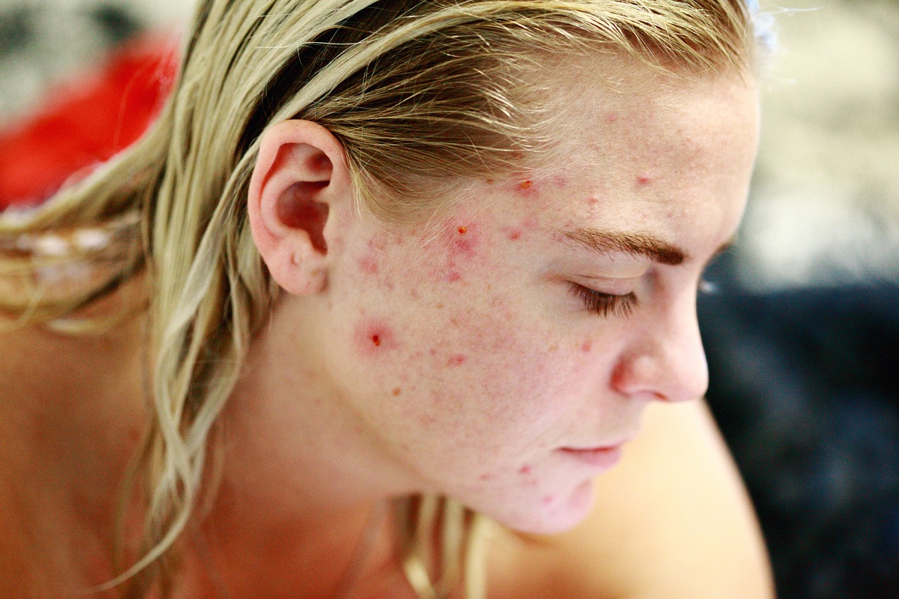 Understanding How to Help with Skin Picking Disorder