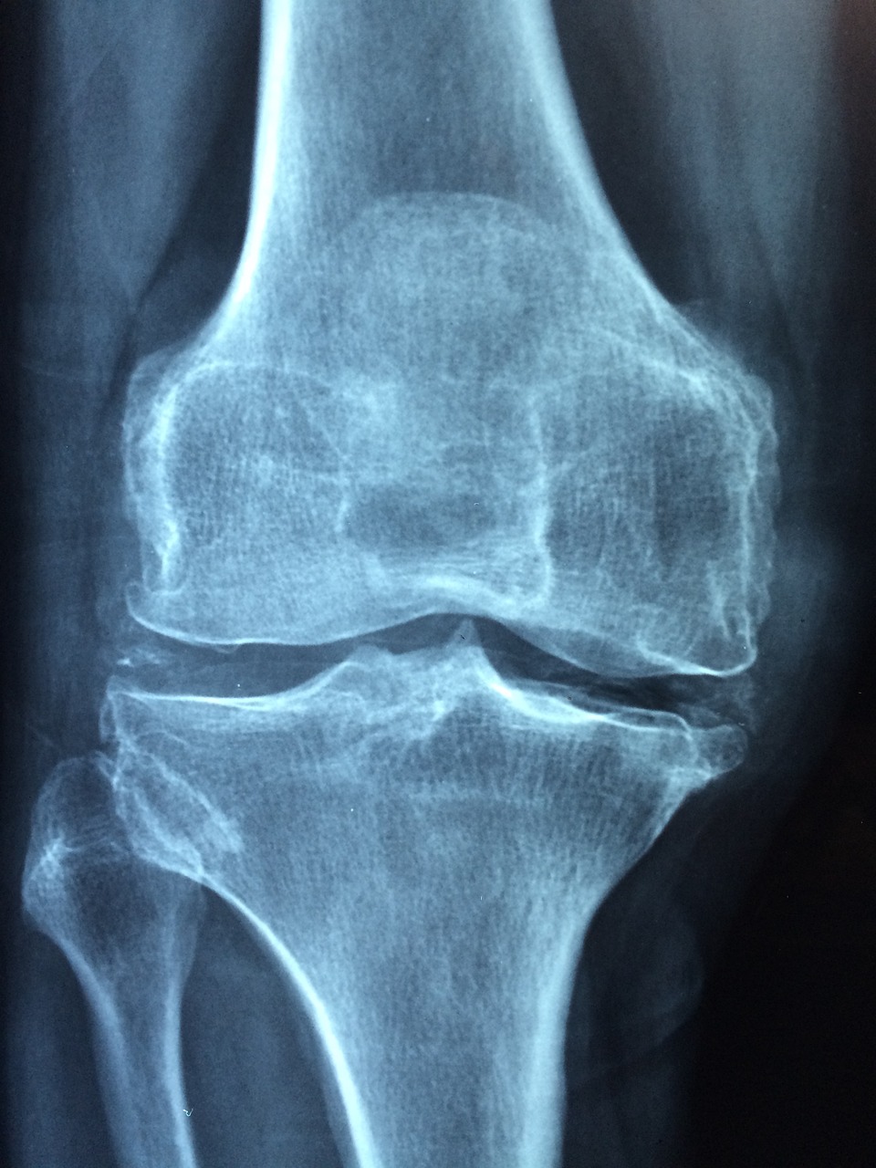 Treating Osteoarthritis: How Physiotherapy Can Help